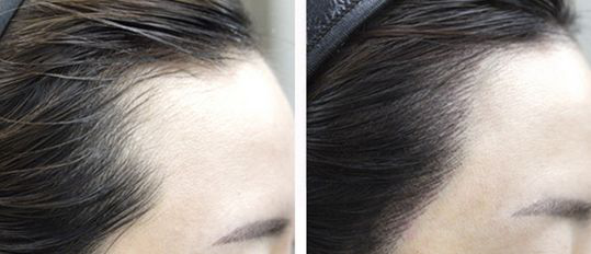 武汉丛琳植发童靖院长：植发必须知道的“三件事”