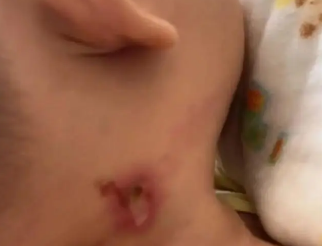 4月大婴儿被高空抛下烟头烫伤！警方排查无人承认，或对全楼住户做DNA