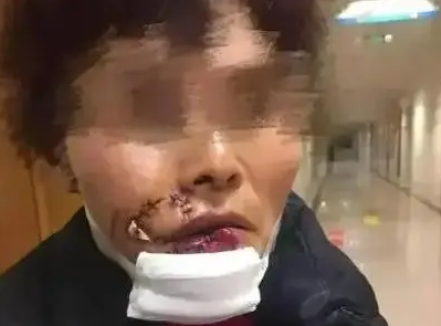 触目惊心！浙江一女子被狗撕碎左脸，缝了500多针