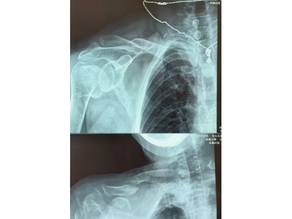 肩关节还能“反”着装?内蒙古包头云龙骨科医院完成首例人工反式肩关节置换术
