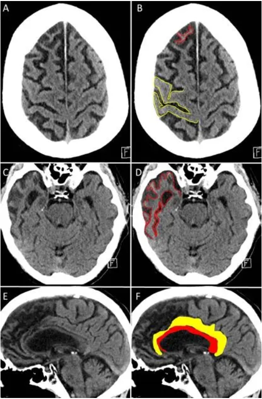 他24岁，刚刚死于痴呆